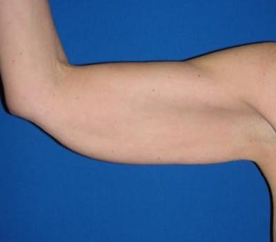 Before Image: Inner Arms Excess Skin Removal - right-side