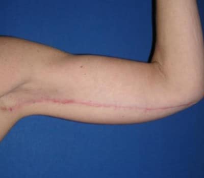After Image: Inner Arms Excess Skin Removal - left-side