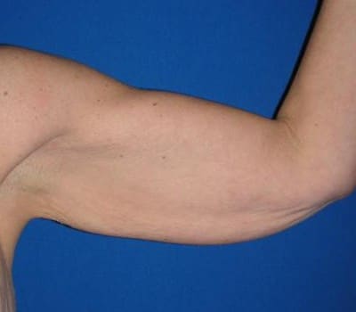 Before Image: Inner Arms Excess Skin Removal - left-side