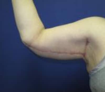 After Image: Inner Arm Lift 4 Months Post-Op - right-side
