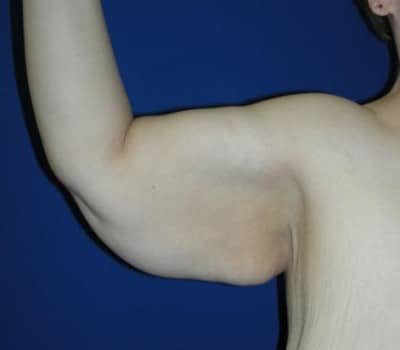 Before Image: Inner Arm Lift 4 Months Post-Op - right-side