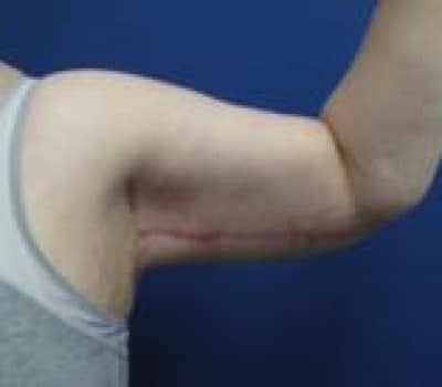 After Image: Inner Arm Lift 4 Months Post-Op - left-side