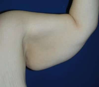 Before Image: Inner Arm Lift 4 Months Post-Op - left-side
