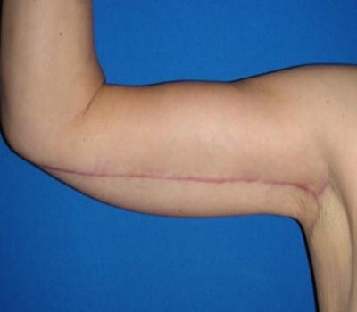 After Image: Bilateral Arm Lift - right-side