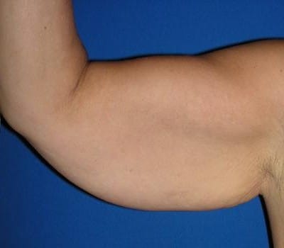 Before Image: Bilateral Arm Lift - right-side