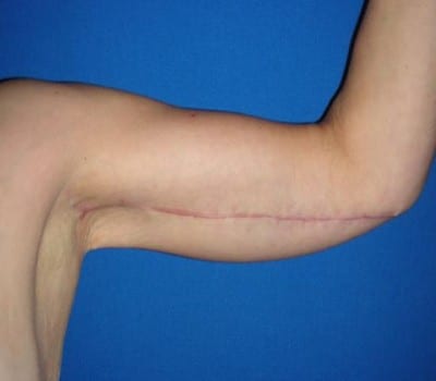 After Image: Bilateral Arm Lift - left-side