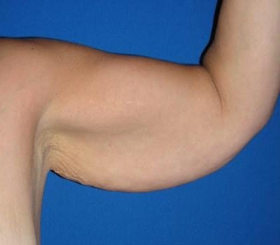 Before Image: Bilateral Arm Lift - left-side
