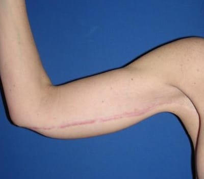 After Image: Bilateral Arm Lift - right-side