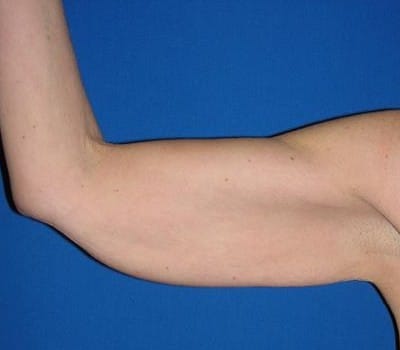 Before Image: Bilateral Arm Lift - right-side