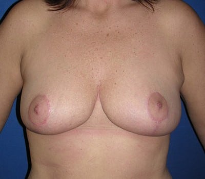 After Image: 4 Months Post-Op - front