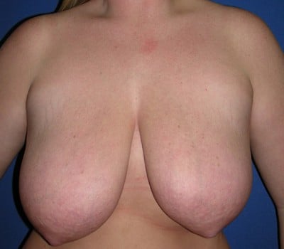 Before Image: 24 Years old - front