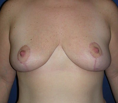 After Image: Improving Breast Position - front