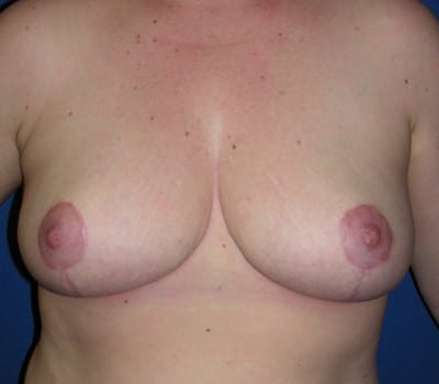 After Image: 6 Months Post-Op - front
