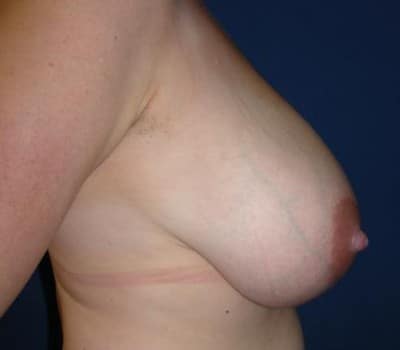 Before Image: 35 Years Old 4 Months Post-Op - other