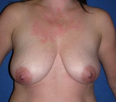 Before Image: 43 Years Old Bilateral Reduction - front