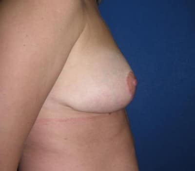 After Image: 43 Years Old Bilateral Reduction - other