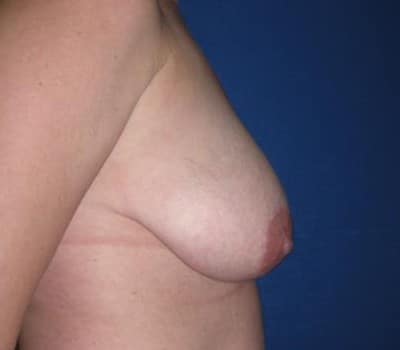 Before Image: 43 Years Old Bilateral Reduction - other