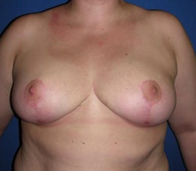 After Image: Bilateral Breast Reduction - front