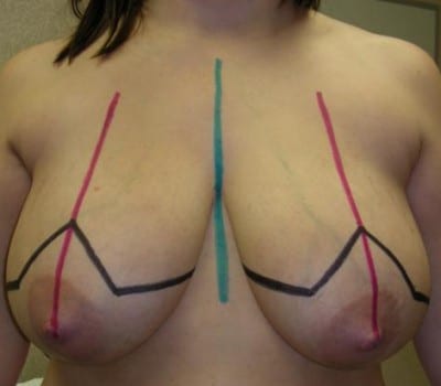 Before Image: 26 Years Old 4 Months Post-Op - front