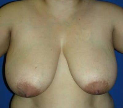 Before Image: 34 Years Old - front