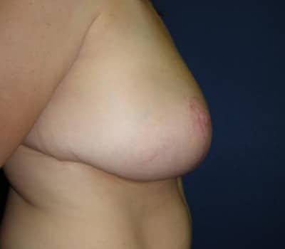 After Image: S/P Bilateral Breast Reduction - other