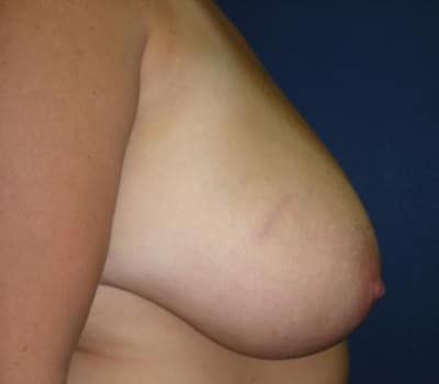 Before Image: S/P Bilateral Breast Reduction - other