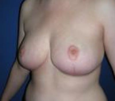 After Image: S/P Bilateral Reduction 4 Months Post-Op - front