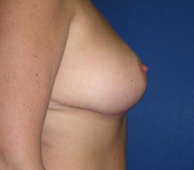 After Image: Removed 540 g left & 517 g right - other