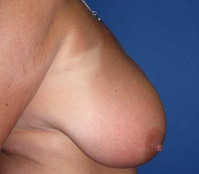 Before Image: Removed 540 g left & 517 g right - other