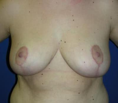 After Image: Removed 736g Right & 685g Left - front