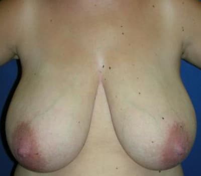 Before Image: Removed 736g Right & 685g Left - front