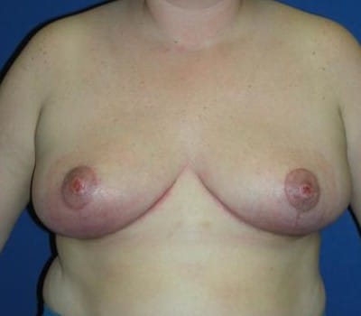 After Image: 6 Weeks Post-Op - front