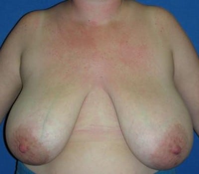 Before Image: 6 Weeks Post-Op - front