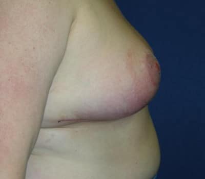 After Image: 6 Weeks Post-Op - other