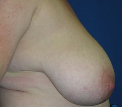 Before Image: 6 Weeks Post-Op - other