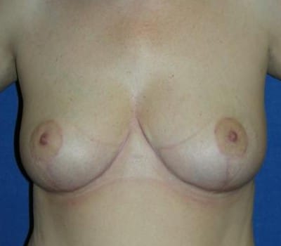 After Image: Removed 172g Right & 418g Left - front