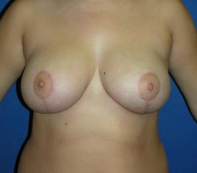 After Image: Removed 817g Right & 440g Left - front