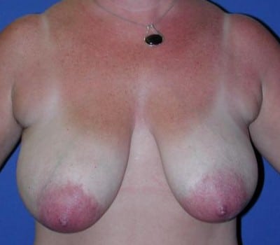 Before Image: Removed 440g Right & 328g Left - front