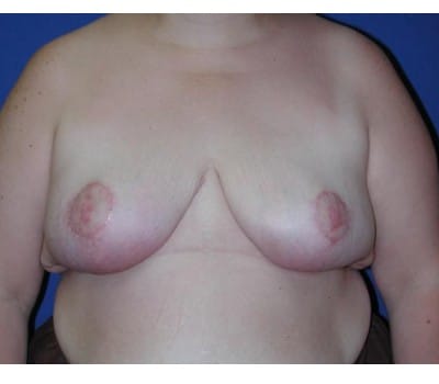 After Image: Removed 1661g Right & 2020g Left - front