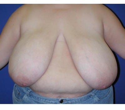 Before Image: Removed 1661g Right & 2020g Left - front