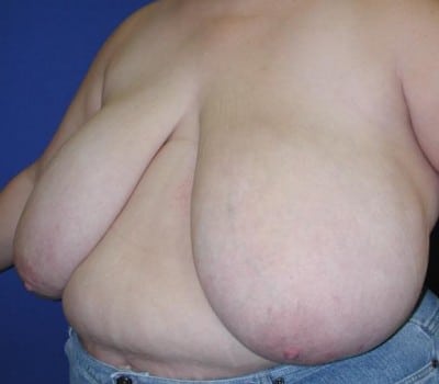 Before Image: Removed 1661g Right & 2020g Left - front