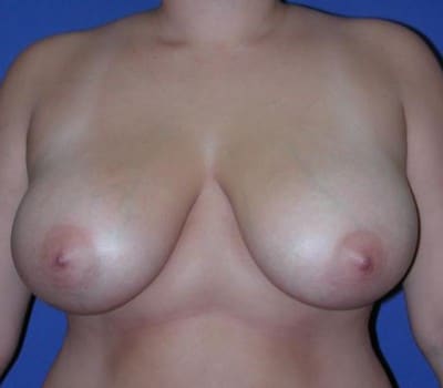 Before Image: Removed 529g Right & 549g Left - front