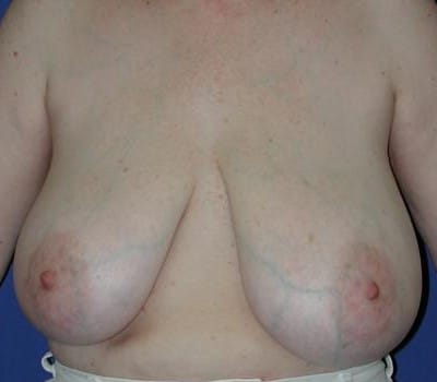 Before Image: Removed 1008g Left & 659g Right - front