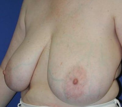 Before Image: Removed 1008g Left & 659g Right - other