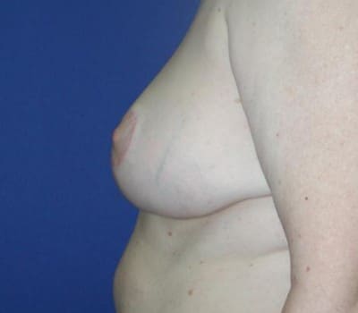 After Image: Removed 1008g Left & 659g Right - other