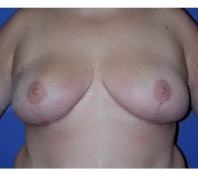 After Image: Removed 808g Right & 709g Left - front