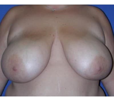 Before Image: Removed 808g Right & 709g Left - front