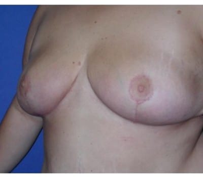 After Image: Removed 808g Right & 709g Left - other