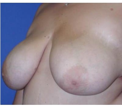 Before Image: Removed 808g Right & 709g Left - other