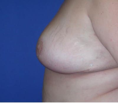 After Image: Removed 808g Right & 709g Left - other